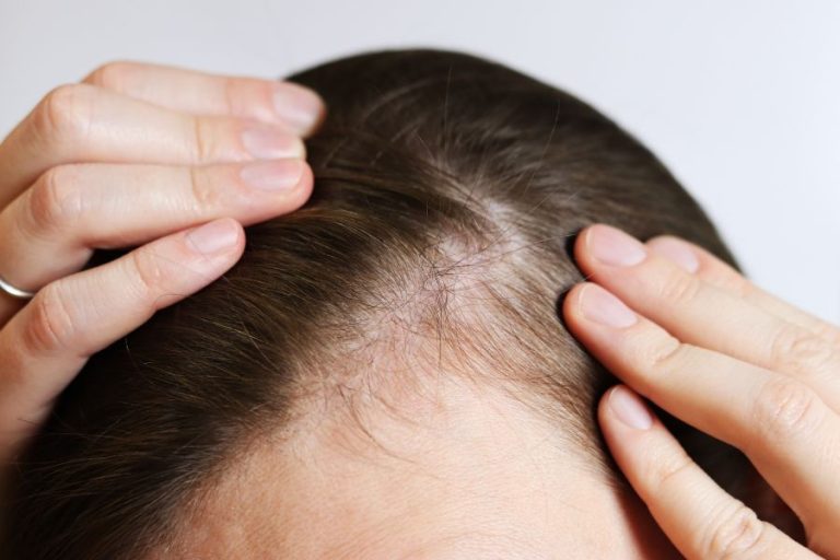 Mujer mostrando zona de alopecia con cabello fino y escaso en el cuero cabelludo