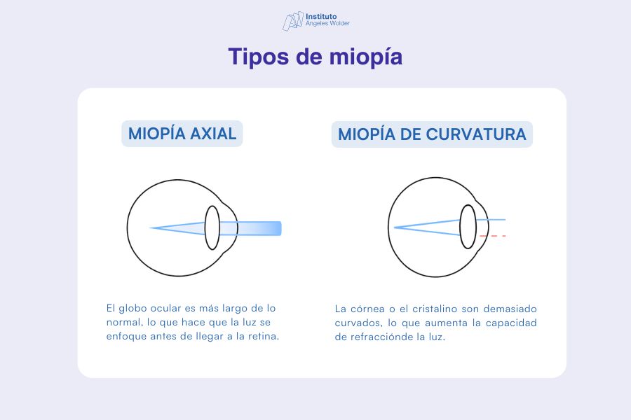 Infografía que explica los tipos de miopía, incluyendo miopía axial y miopía de curvatura, con ilustraciones del ojo