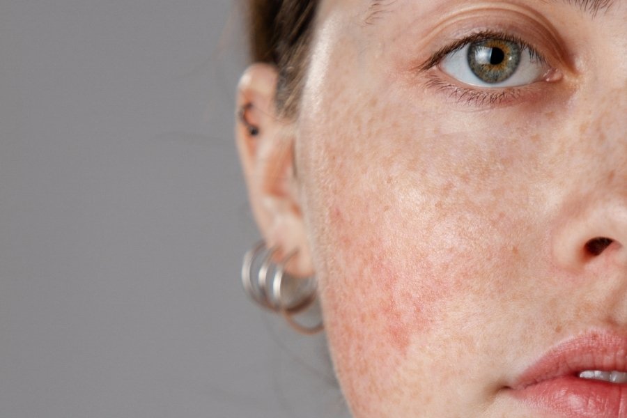 Mujer con rosácea visible en la mejilla, mostrando enrojecimiento y piel irritada en un retrato de cerca